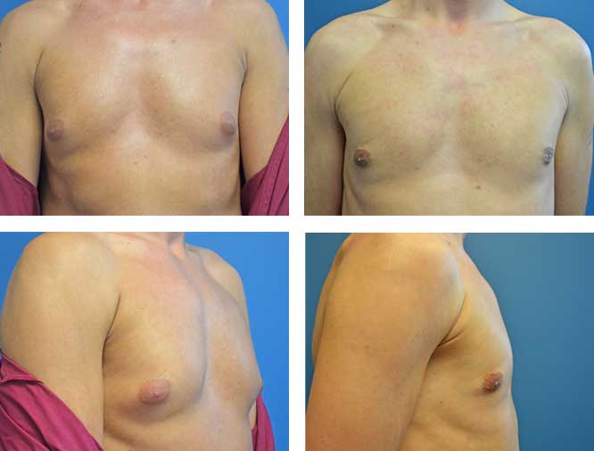Gynecomastia in Dubai